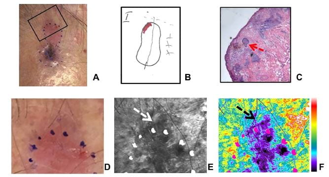 P. Rohani, A. N. Yaroslavsky, X Feng, PR Jermain, T Shaath, and VA Neel, “Collagen Disruption as a Marker for Basal Cell Carcinoma in Presurgical Margin Detection,”. Laser Surg Med. 50(9), 902-907 (2018).