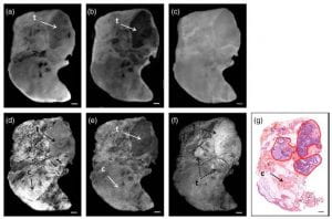Patel R, Khan A, Wirth D, Kamionek M, Kandil D, Quinlan R, and Yaroslavsky AN, “Multimodal optical imaging for detecting breast cancer,” J. Biomed. Opt. 17(6), (2012).